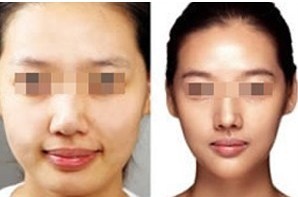 鼻頭鼻翼縮小——李小姐