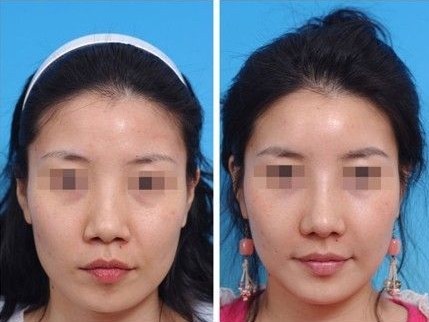 鼻尖成形術(shù)——趙小姐