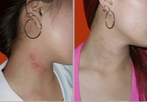 頸部疤痕修復(fù)——錢(qián)小姐