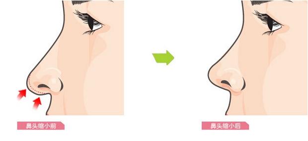 鼻翼縮小.jpg