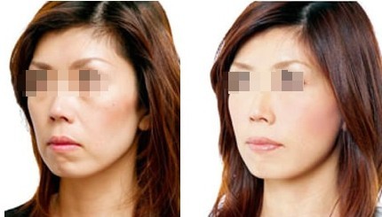 愛貝芙注射除皺——毛女士