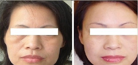 去口周紋——茍女士