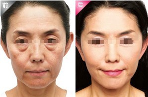 注射去除魚尾紋——武女士