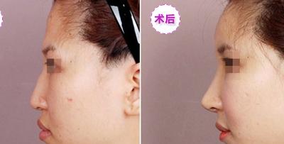 隆鼻4.jpg