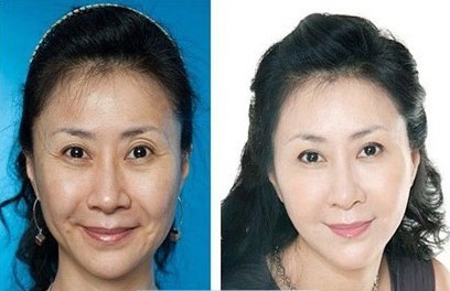 激光去皺——王女士