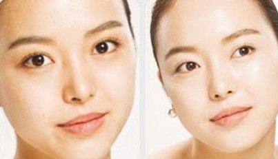 激光美白——梁小姐