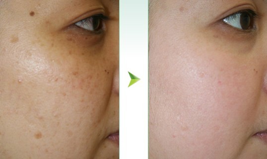 激光去斑——劉女士