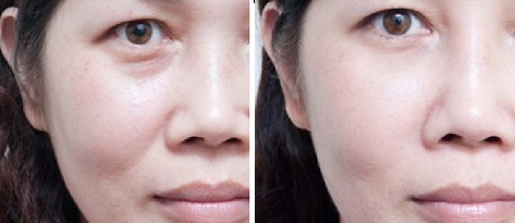 伊維蘭去法令紋——姚女士