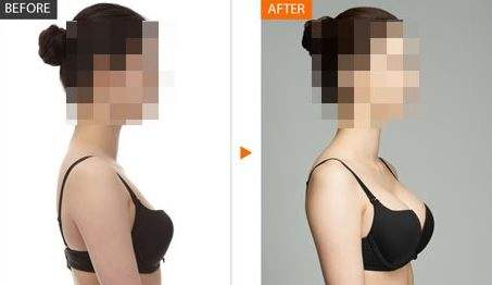 假體隆胸-林賢超醫(yī)生手術(shù)