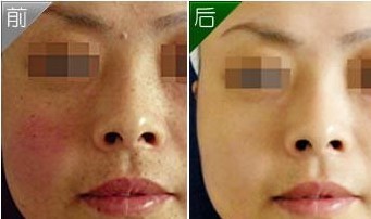 去紅血絲——王女士