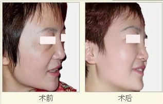 去口周紋——馬女士