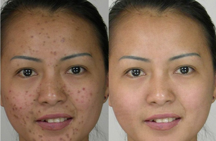 激光祛痘印——林女士