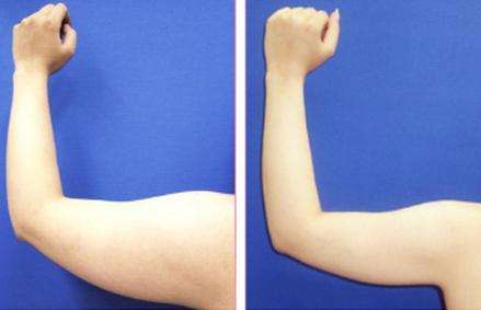 手臂吸脂2-林賢超