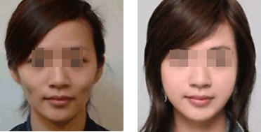 面部填充——李小姐