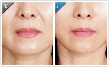 鼻唇溝填充——郭女士
