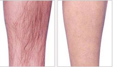 小腿冰點脫毛——劉先生