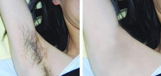 腋下冰點脫毛——甄女士