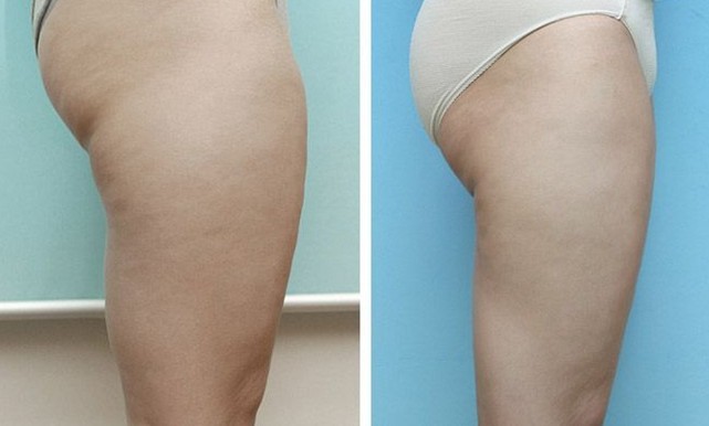 腿部吸脂——吳女士