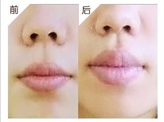 薄唇變厚手術(shù)——夏女士