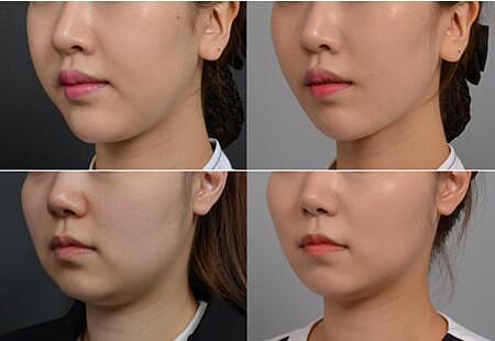 假體下巴.jpg