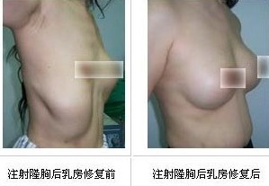 隆胸失敗修復(fù)成功案例——利女士