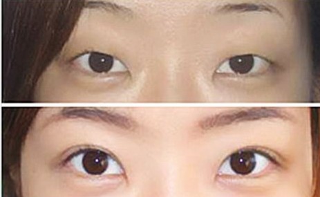雙眼皮手術成功案例——田小姐