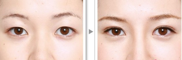 韓式重瞼術——楊小姐