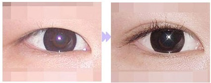 雙眼皮手術——張小姐