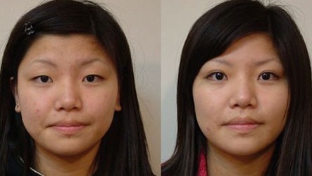 韓式重瞼術——錢女士