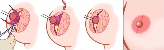 乳頭乳暈矯正